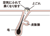 黒ずみ原因２：　ホルモンバランスの崩れによるもの
